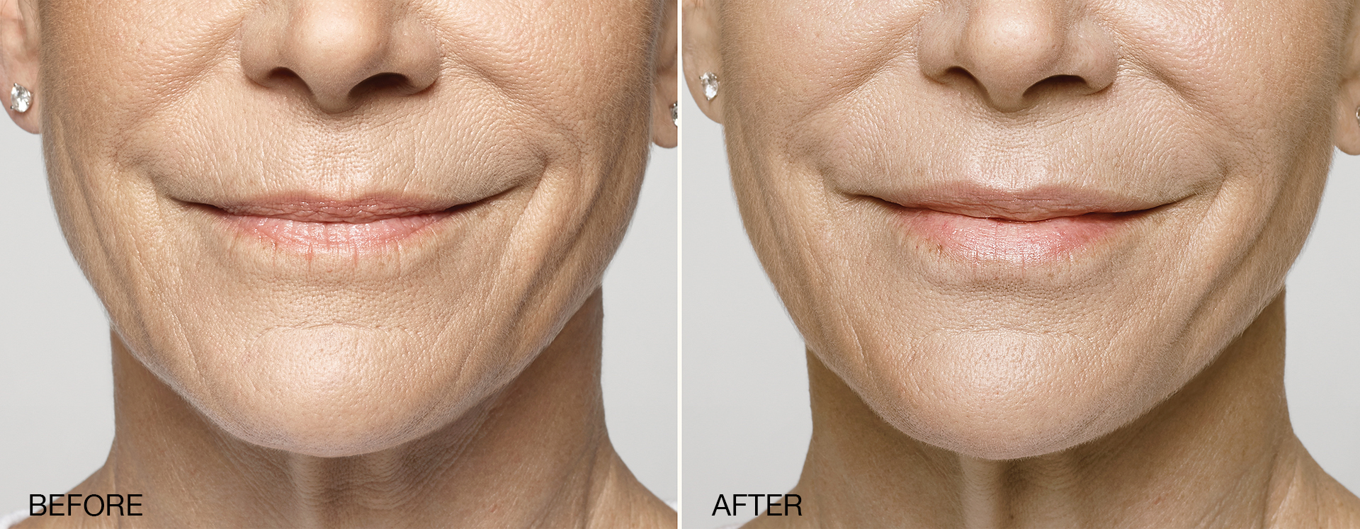Restylane®/Restylane® Silk in Tampa and St. Petersburg, FL