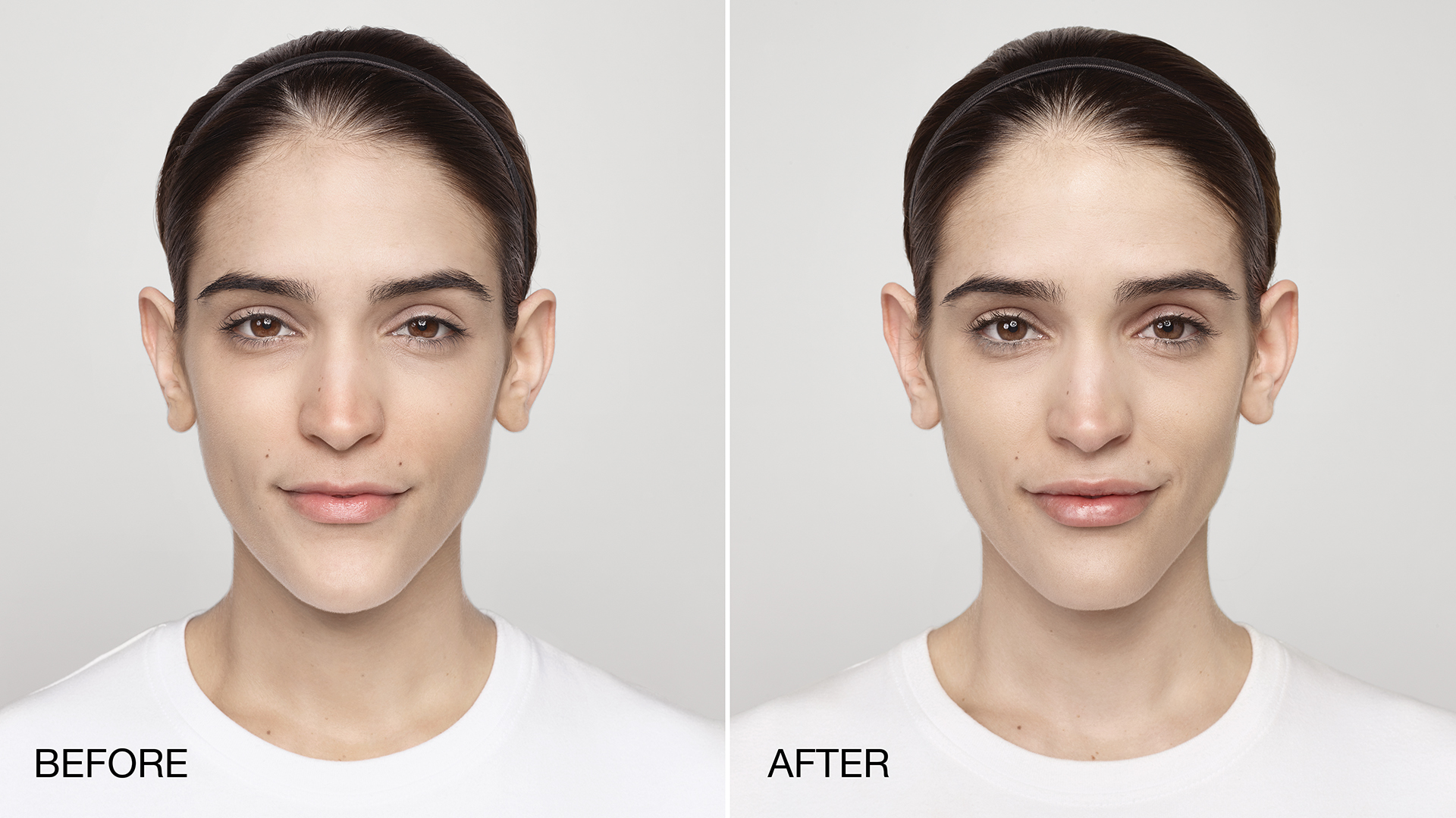 Restylane®/Restylane® Silk in Tampa and St. Petersburg, FL
