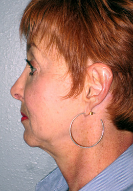 Before and After Pictures - Davis Facial Plastic Surgery