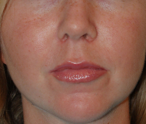 Before and After Pictures - Davis Facial Plastic Surgery