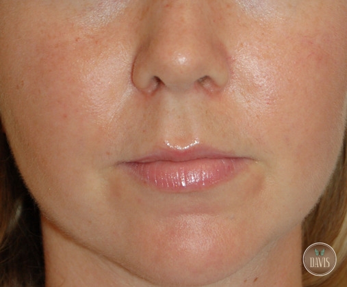 Cosmetic Injectables and Fillers Before and After Pictures Tampa and St. Petersburg, FL