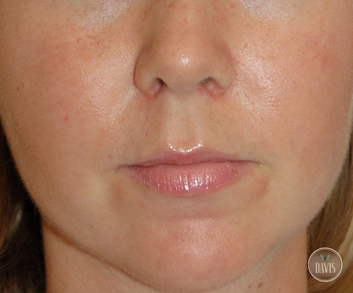 Before and After Pictures - Davis Facial Plastic Surgery