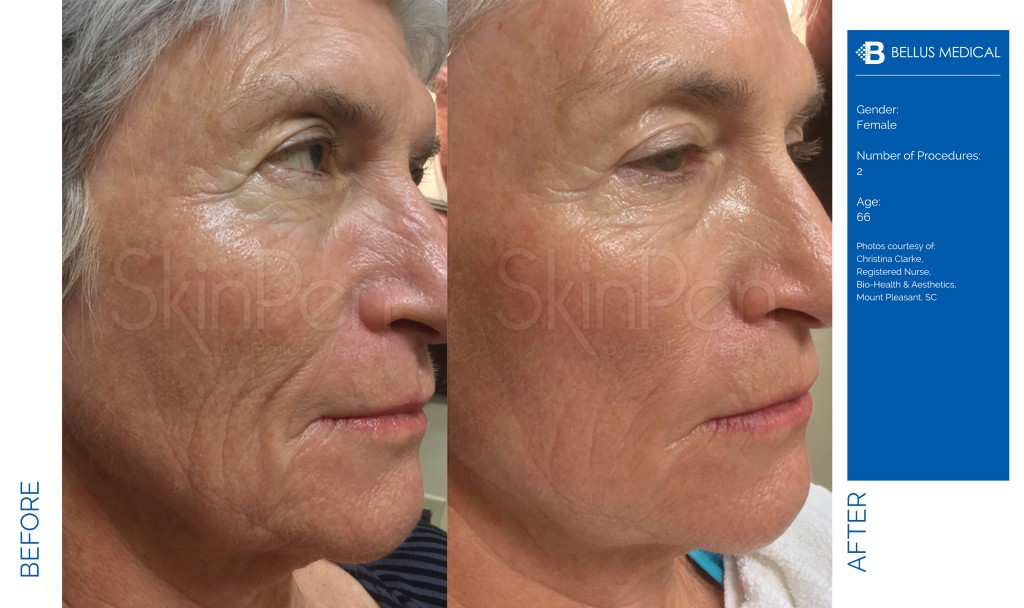 SkinPen® Microneedling in Tampa and St. Petersburg, FL