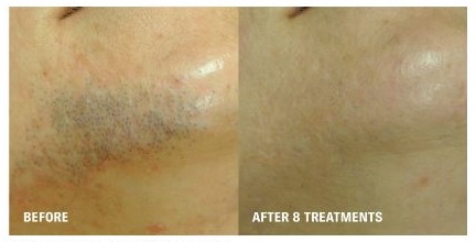 Laser Hair Removal Before and After Pictures Tampa, FL
