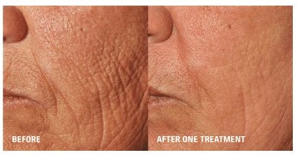 Laser Resurfacing Before and After Pictures Tampa, FL