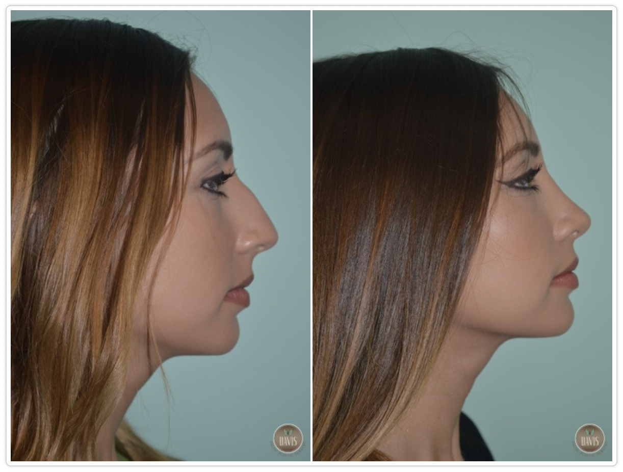 Rhinoplasty Before and After Pictures Tampa, FL