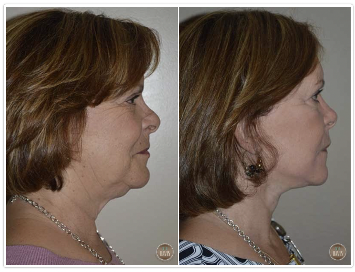 Facelift Before and After Pictures Tampa, FL
