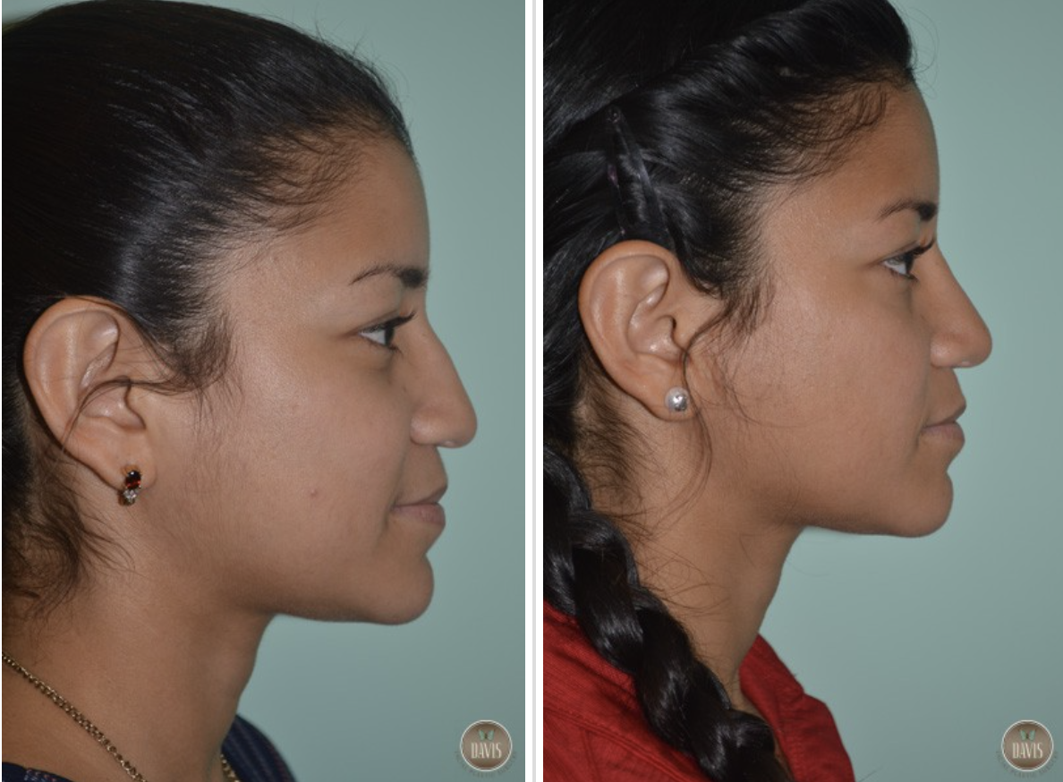Ethnic Rhinoplasty Before and After Pictures Tampa, FL