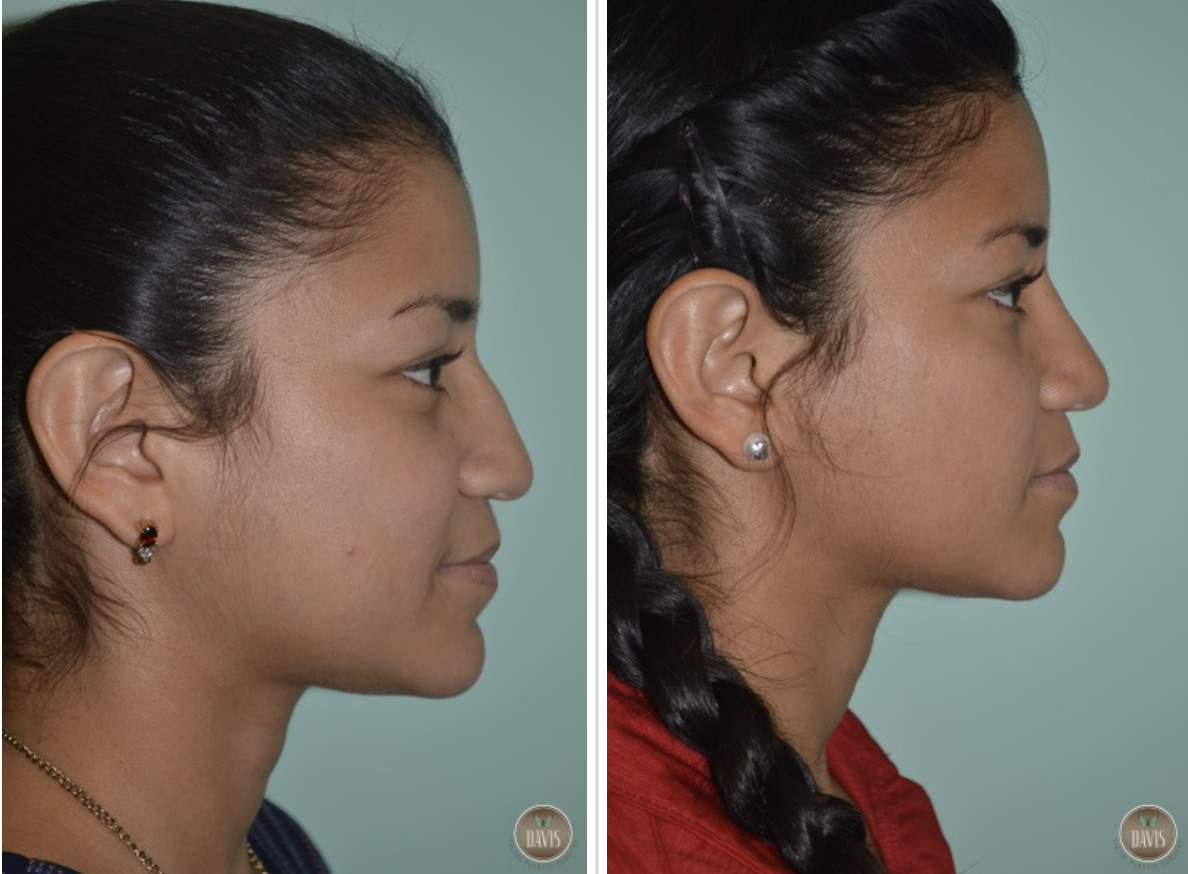 Screen Shot 2023-05-18 at 3.05.09 PM Ethnic Rhinoplasty Before and After Pictures Tampa, FL