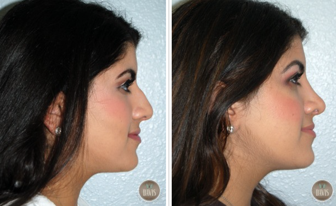 Ethnic Rhinoplasty Before and After Pictures Tampa, FL
