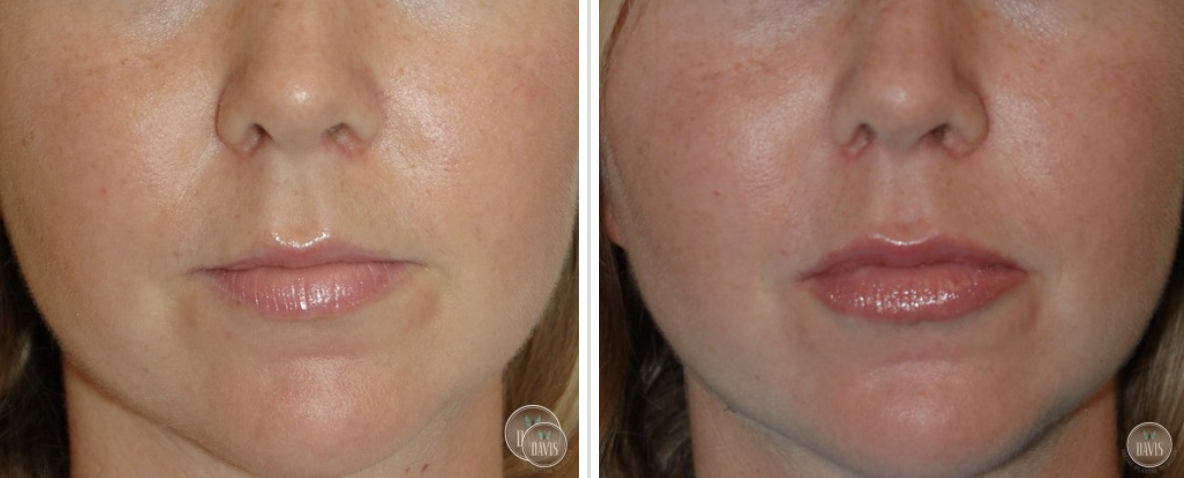 Lip Augmentation Before and After Pictures Tampa and St. Petersburg, FL