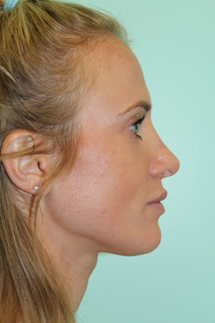 Before and After Pictures - Davis Facial Plastic Surgery