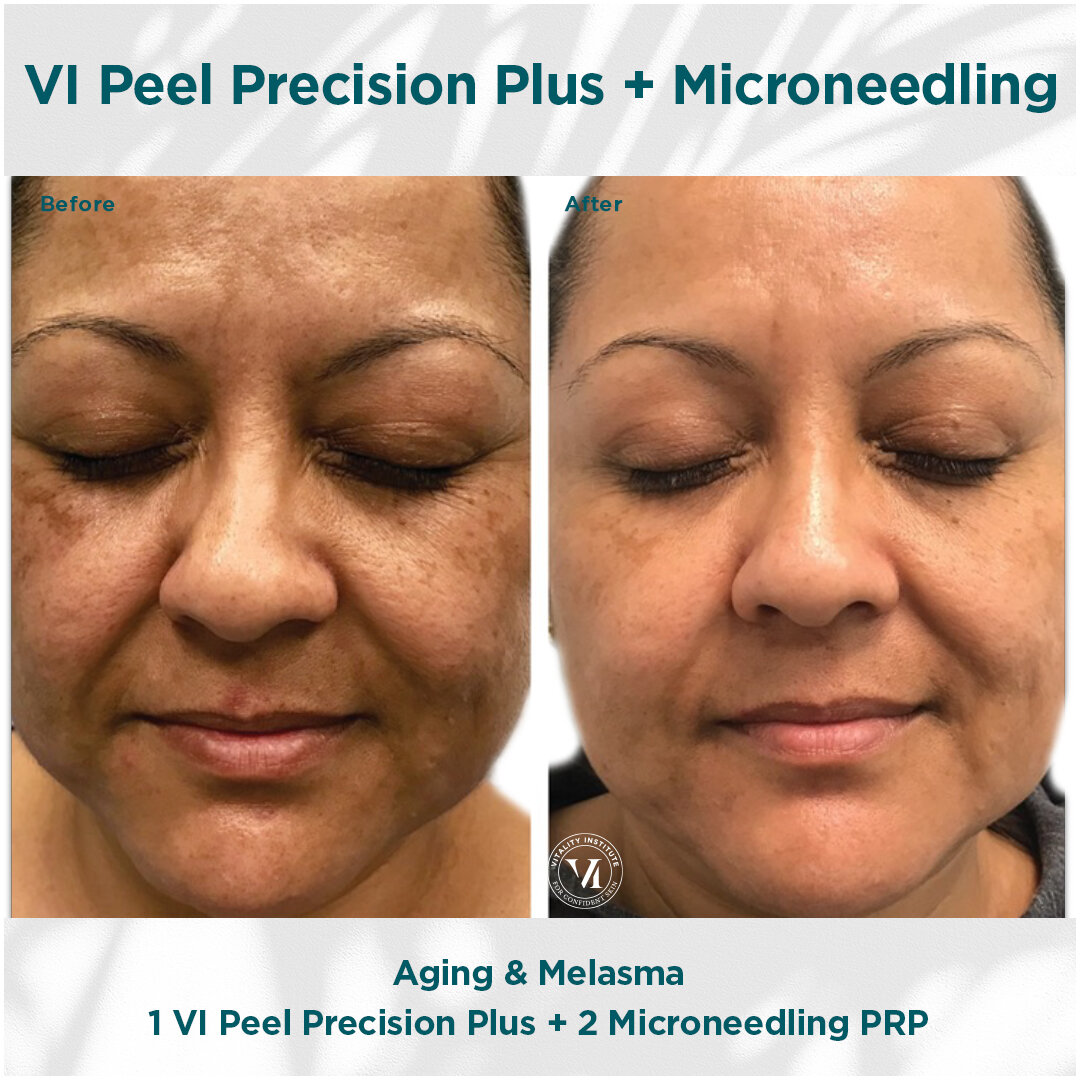 VI Peel Precision Plus with Microneedling with PRP Cosmetic Injectables and Fillers Before and After Pictures Tampa and St. Petersburg, FL