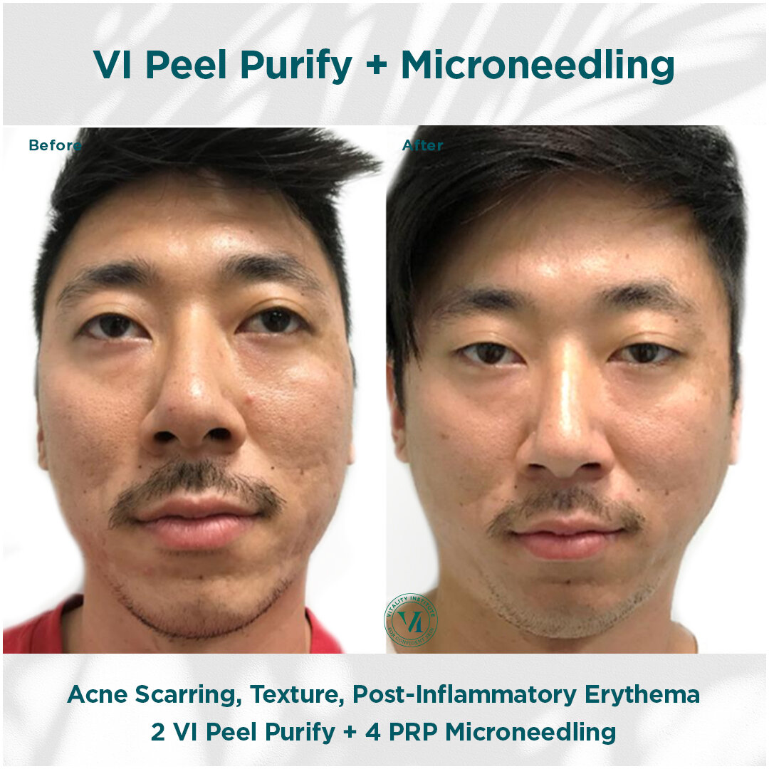 VI Peel Purify with Microneedling with PRP Cosmetic Injectables and Fillers Before and After Pictures Tampa and St. Petersburg, FL