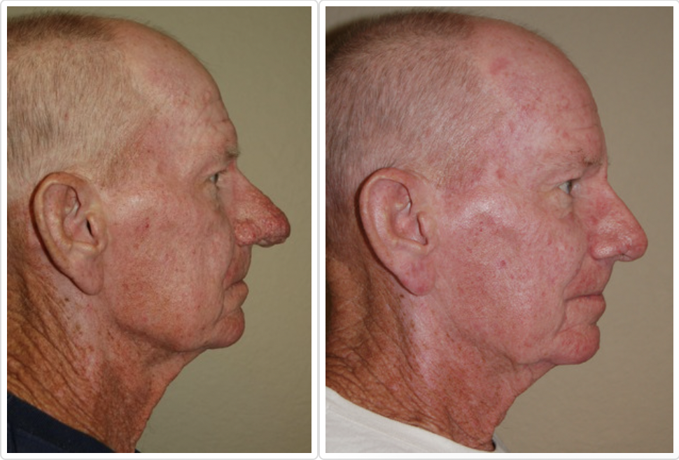 Rhinophyma Before and After Pictures Tampa and St. Petersburg, FL