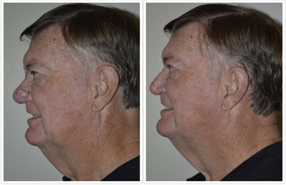 Rhinophyma Before and After Pictures Tampa and St. Petersburg, FL