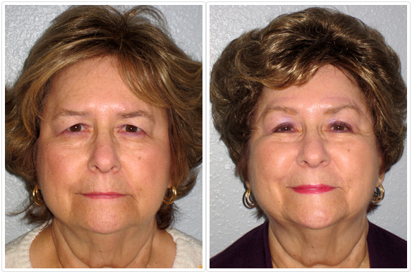 Browlift Before and After Pictures Tampa, FL