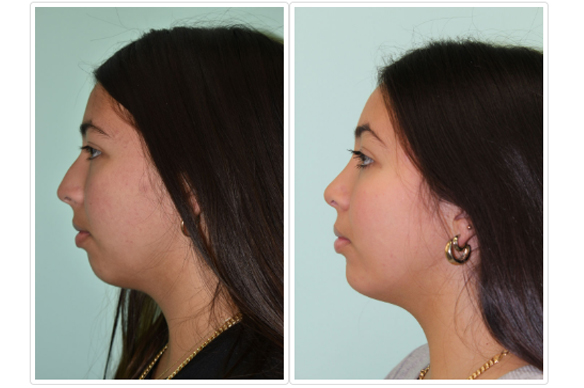 Chin Augmentation Before and After Pictures Tampa, FL