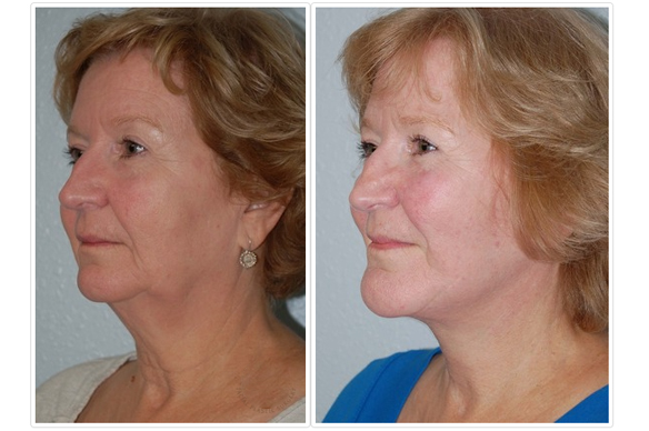 Chin Augmentation Before and After Pictures Tampa, FL