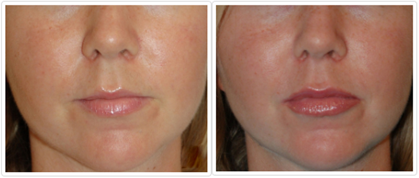 Cosmetic Injectables and Fillers Before and After Pictures Tampa, FL