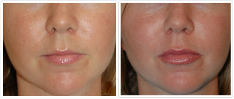 Cosmetic Injectables and Fillers1 Cosmetic Injectables and Fillers Before and After Pictures Tampa, FL