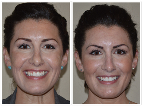 Cosmetic Injectables and Fillers Before and After Pictures Tampa, FL