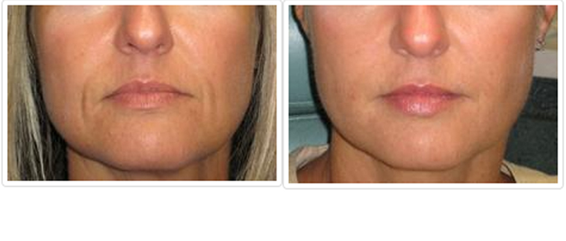 Cosmetic Injectables and Fillers Before and After Pictures Tampa, FL