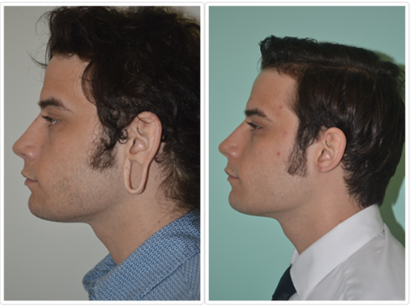 Earlobe Repair Before and After Pictures Tampa and St. Petersburg, FL