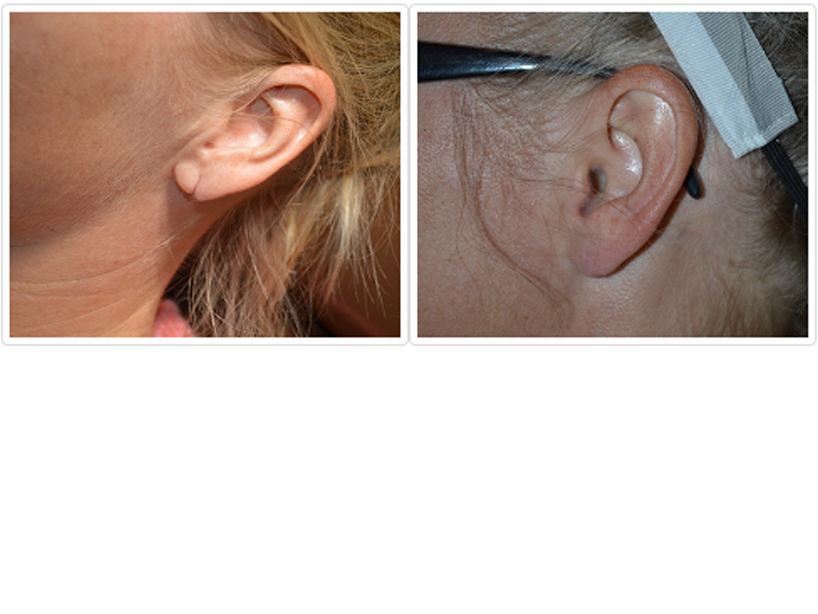 Earlobe Repair Before and After Pictures Tampa and St. Petersburg, FL