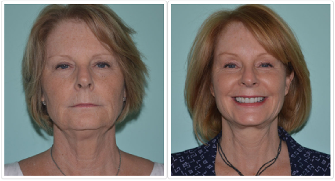 Upper Eyelid Surgery Before and After Pictures Tampa, FL
