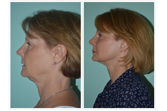 Facelift Before and After Pictures Tampa, FL