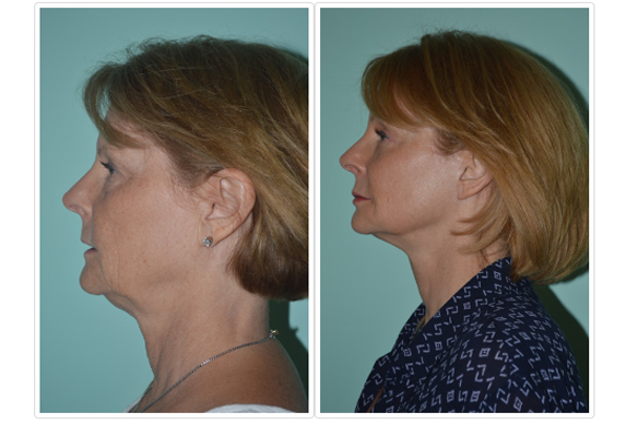 Facelift1 Facelift Before and After Pictures Tampa, FL