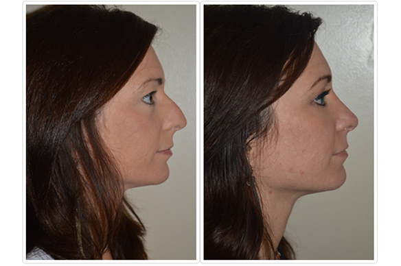 Female Rhinoplasty Before and After Pictures Tampa, FL