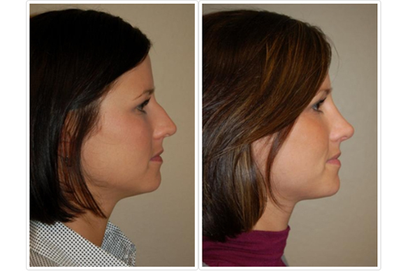 Female Rhinoplasty Before and After Pictures Tampa, FL