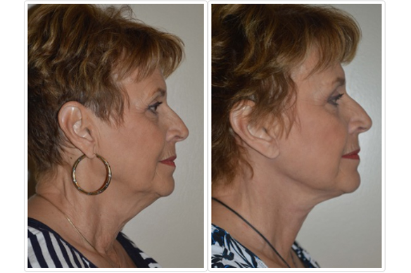 Neck Lift Before and After Pictures Tampa, FL