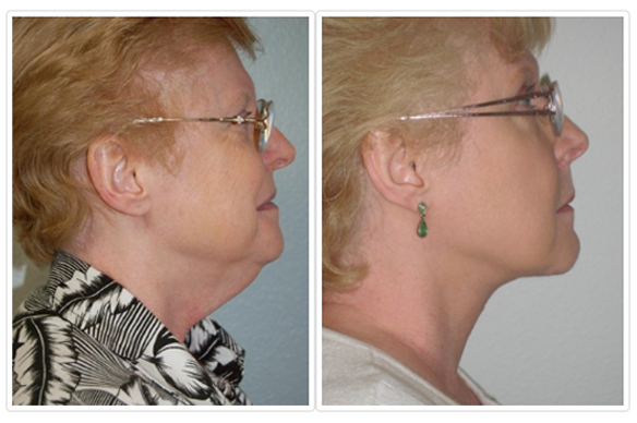 Neck Lift Before and After Pictures Tampa, FL