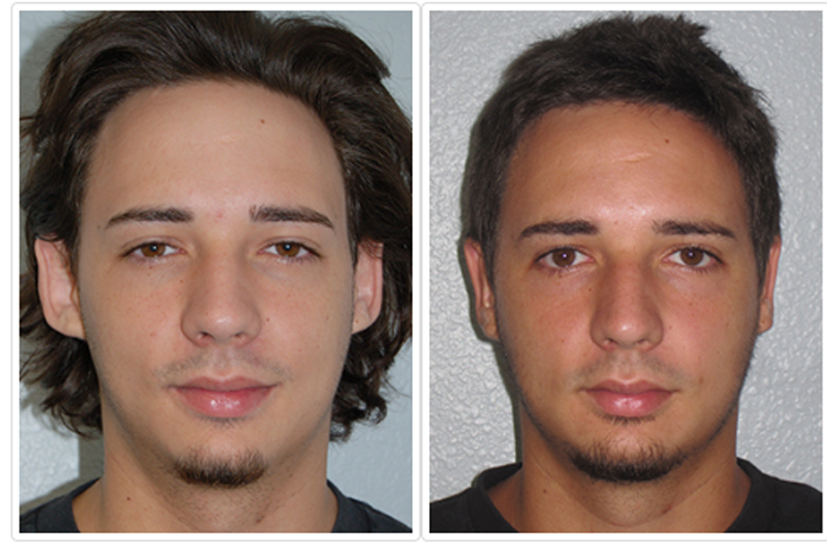 Otoplasty Before and After Pictures Tampa, FL