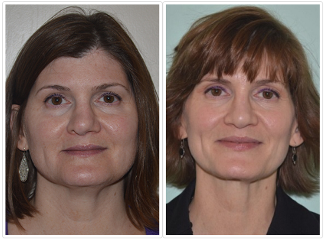 Revision Rhinoplasty Before and After Pictures Tampa, FL