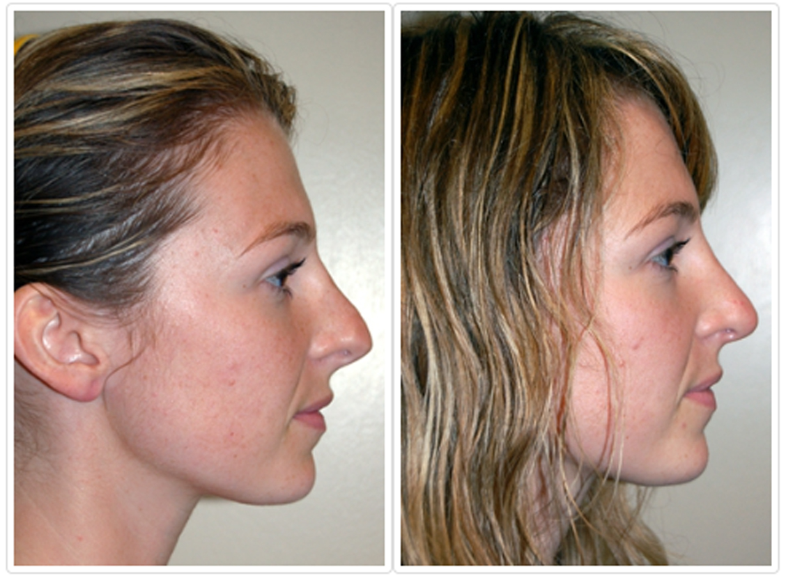 Revision Rhinoplasty Before and After Pictures Tampa, FL