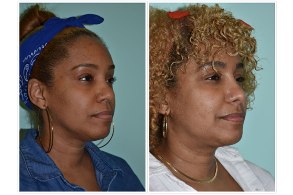 Rhinoplasty Before and After Pictures Tampa, FL