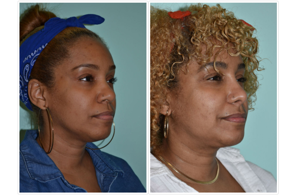 Rhinoplasty Rhinoplasty Before and After Pictures Tampa, FL