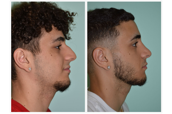 Rhinoplasty Before and After Pictures Tampa, FL