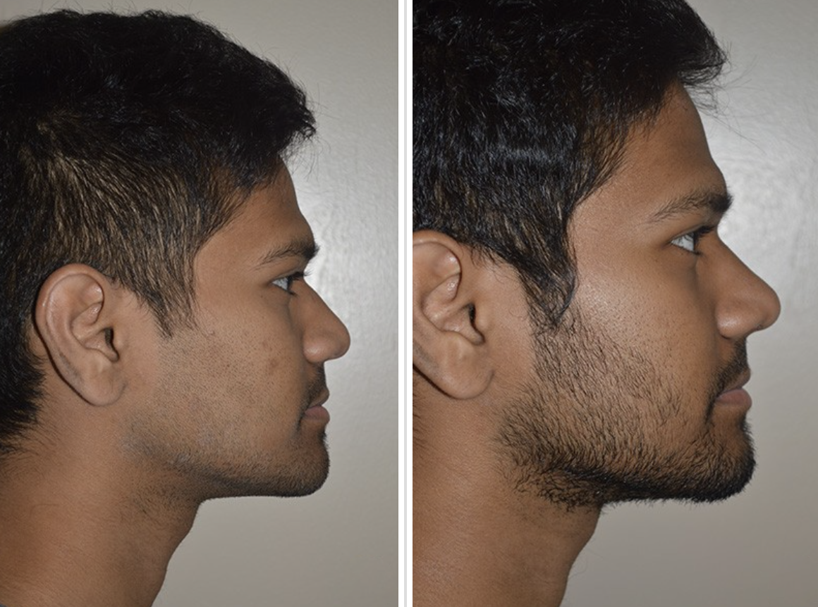 Male Rhinoplasty Before and After Pictures Tampa, FL