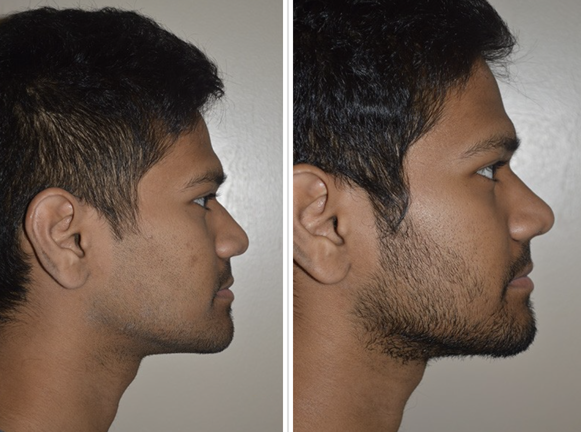 Screen-Shot-2023-05-18-at-2.58.12-PM Male Rhinoplasty Before and After Pictures Tampa, FL