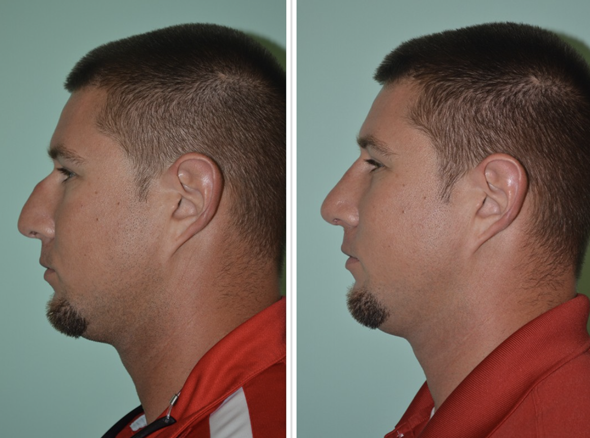 Male Rhinoplasty Before and After Pictures Tampa, FL