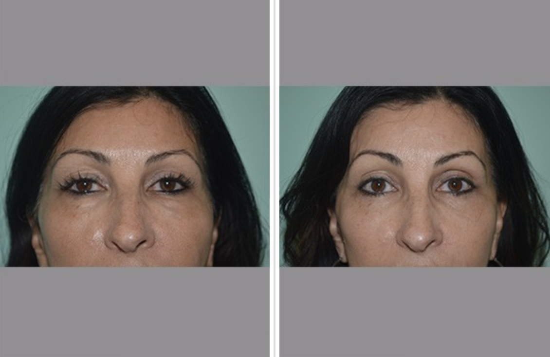 Lower Eyelid Lift (Blepharoplasty) Before and After Pictures Tampa and St. Petersburg, FL