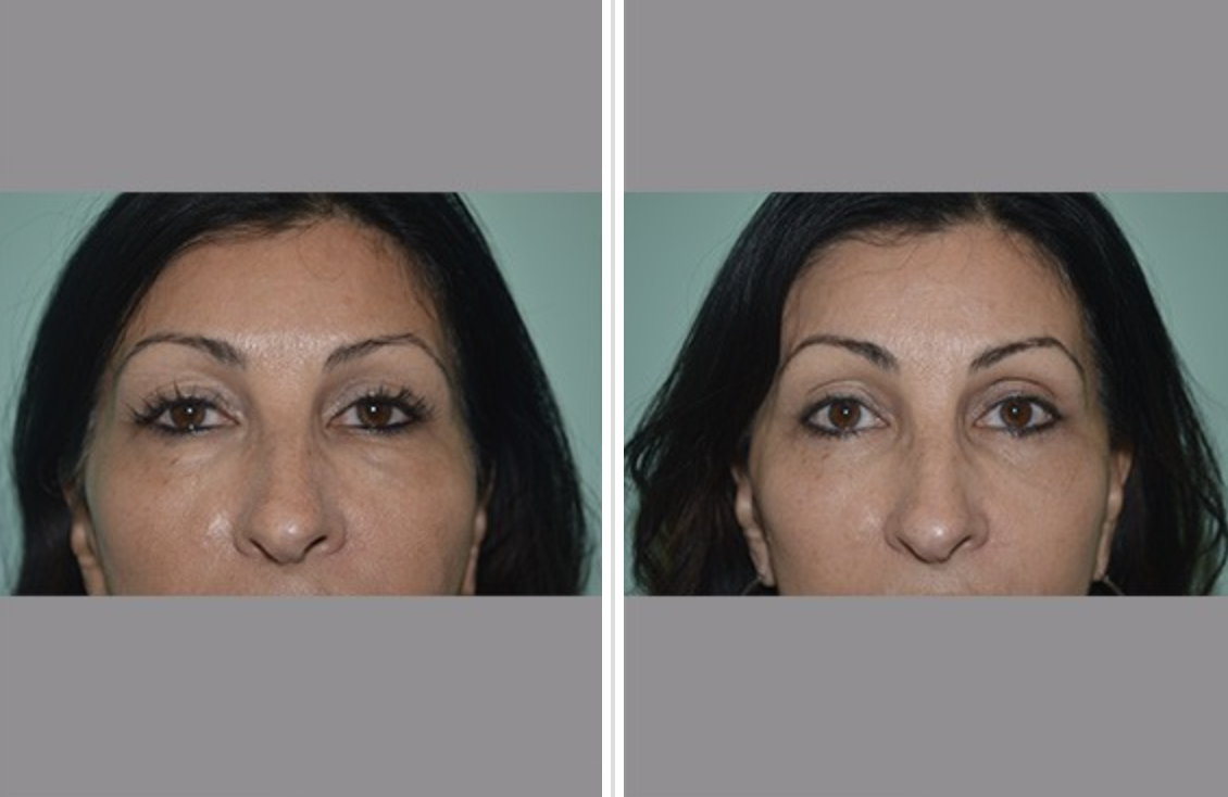 Screen-Shot-2023-05-18-at-3.27.42-PM Lower Eyelid Lift (Blepharoplasty) Before and After Pictures Tampa and St. Petersburg, FL