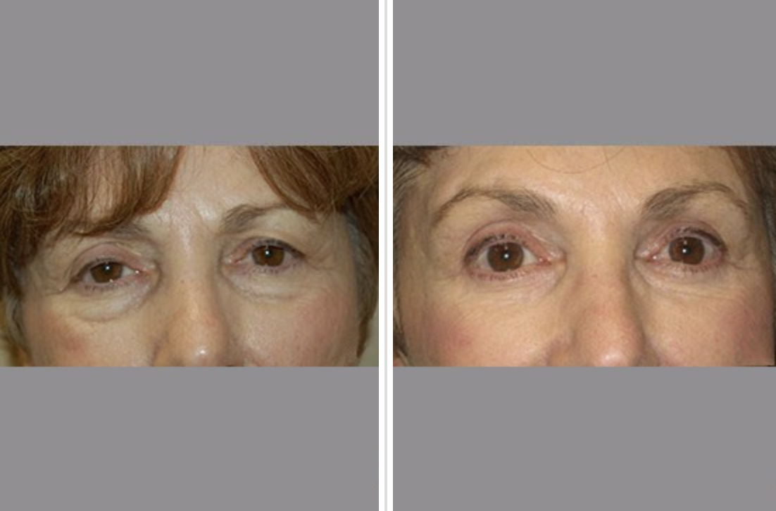 Lower Eyelid Lift (Blepharoplasty) Before and After Pictures Tampa and St. Petersburg, FL