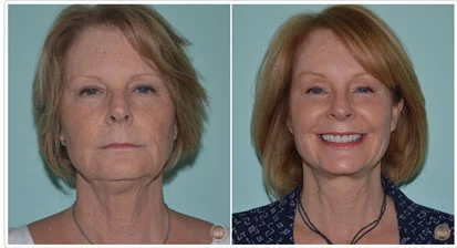 Upper Eyelid Lift/Blepharoplasty Before and After Pictures Tampa, FL