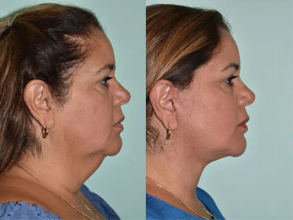 Facelift Before and After Pictures Tampa, FL